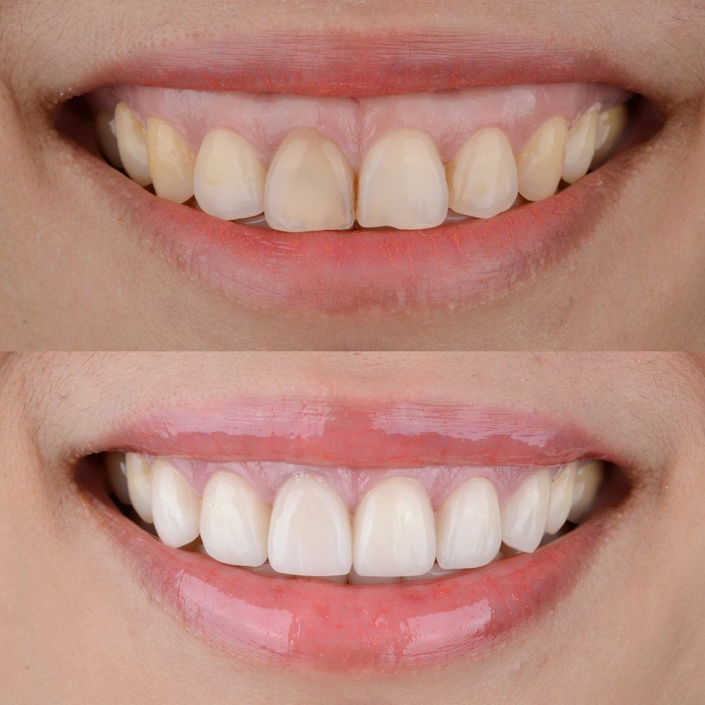 Điều trị cười hở lợi tại YenLe Dental